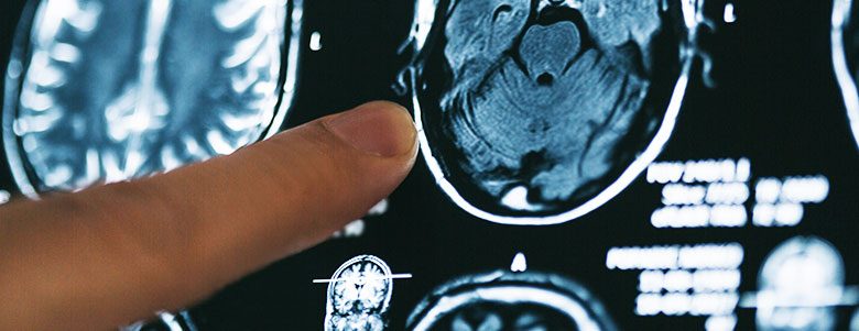 ALZHEIMER